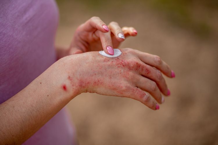 Atopijski dermatitis